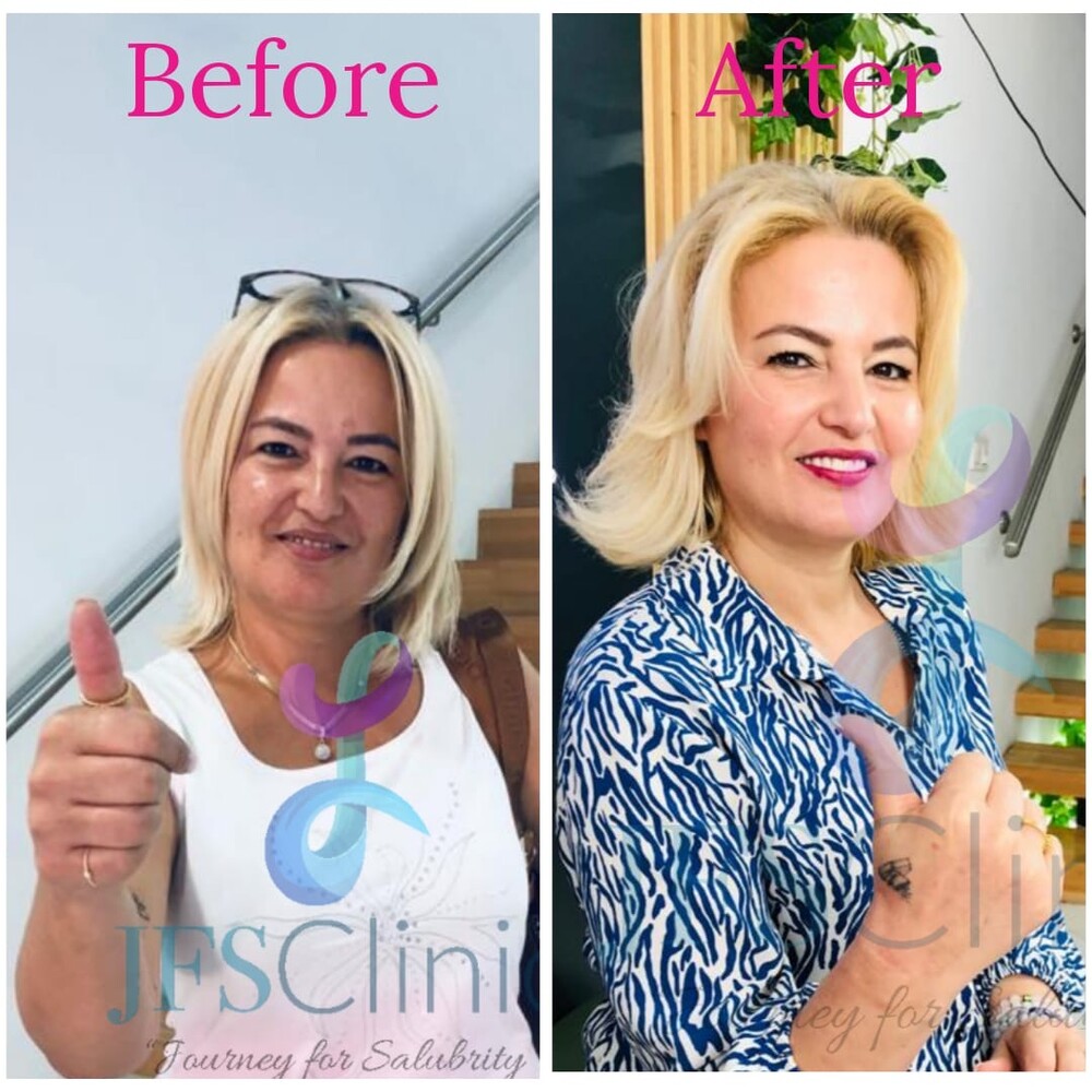 Before and After Result